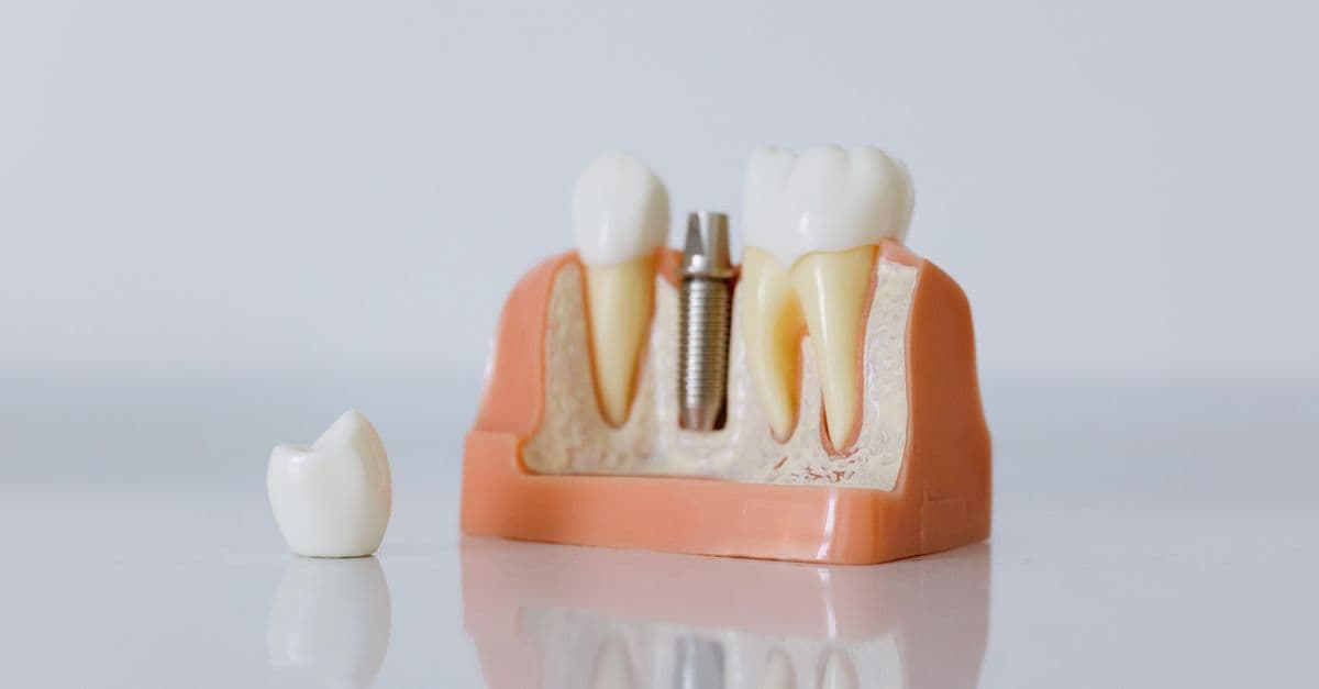 Close-up of a dental implant model featuring artificial teeth and jaw structure.