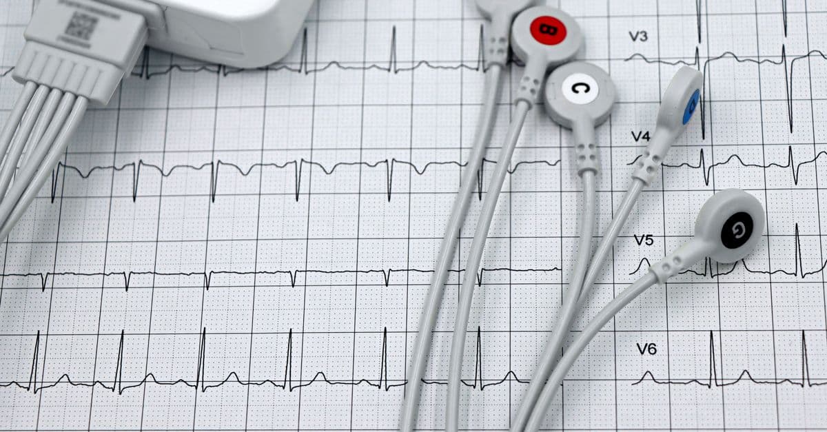 Close-up of ECG monitor leads on a printed cardiogram, showcasing heart health diagnostics.